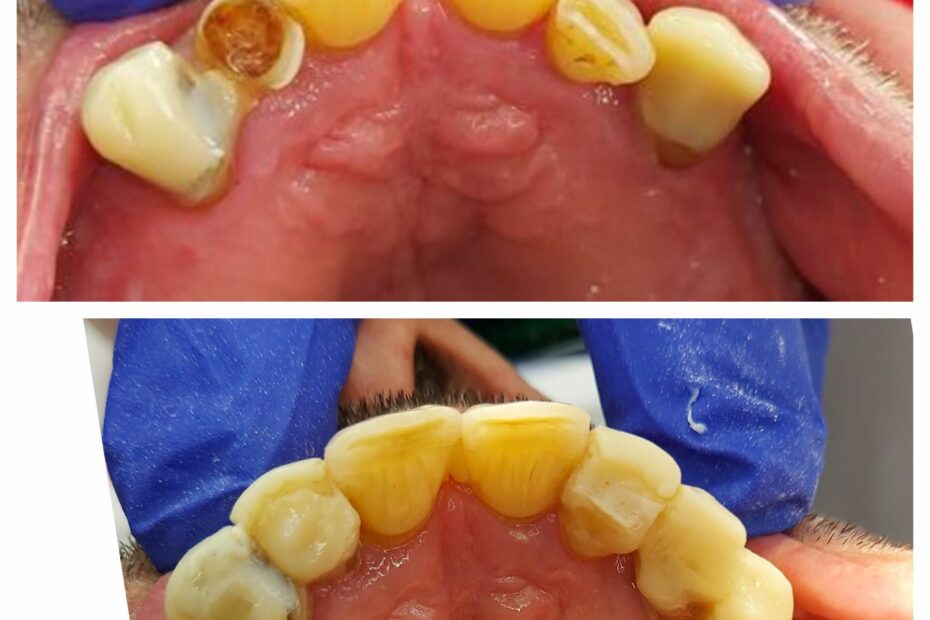 Reconstruction of worn teeth with composite 2