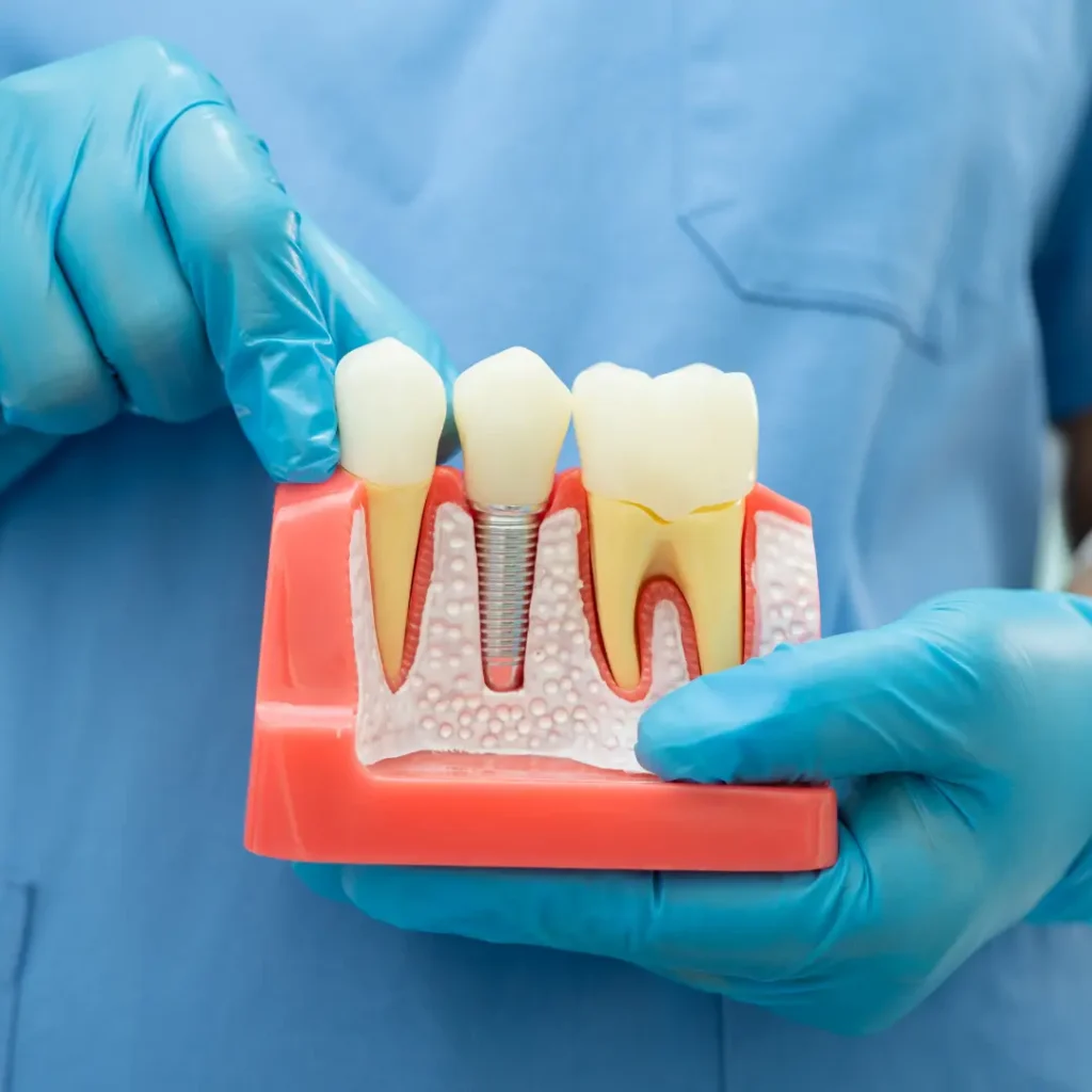 Tooth replacement