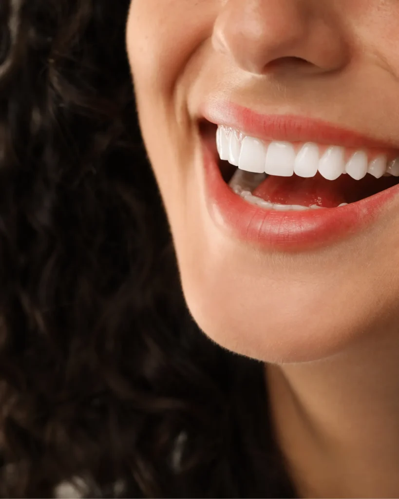 Composite Veneers