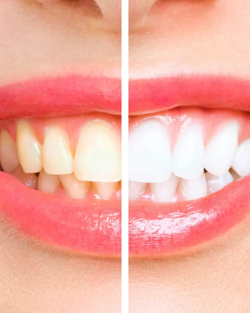 Home Whitening