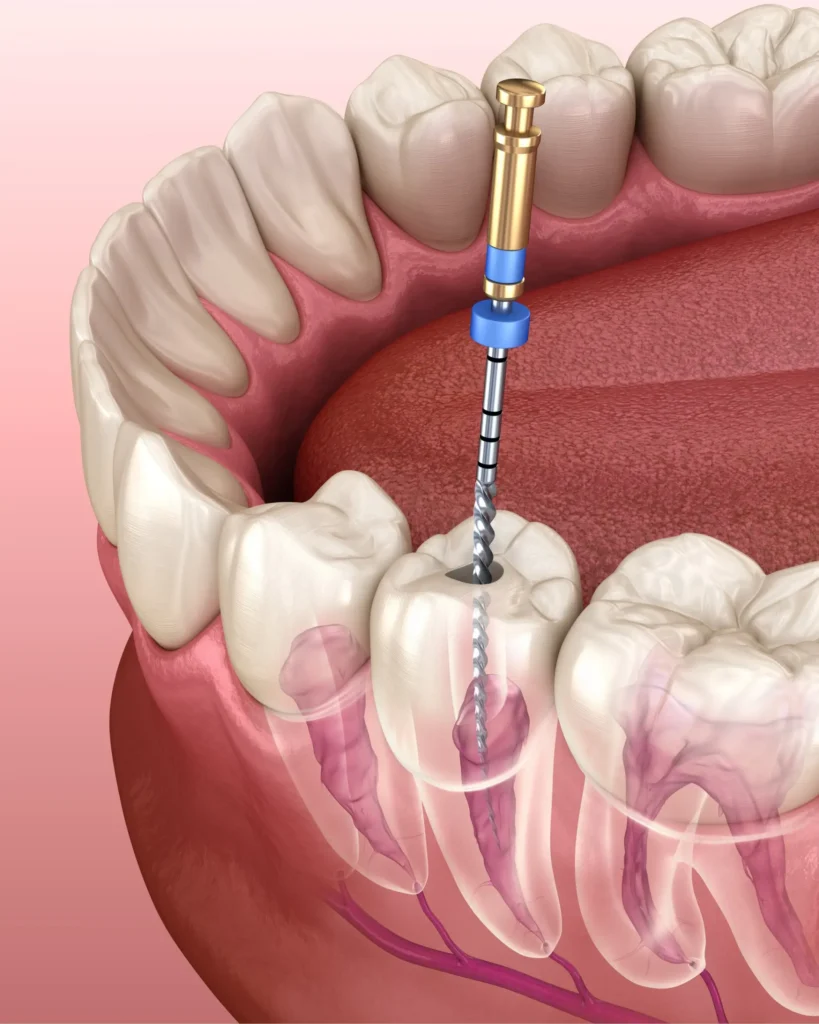 Endodontic Treatment (Root Canal)